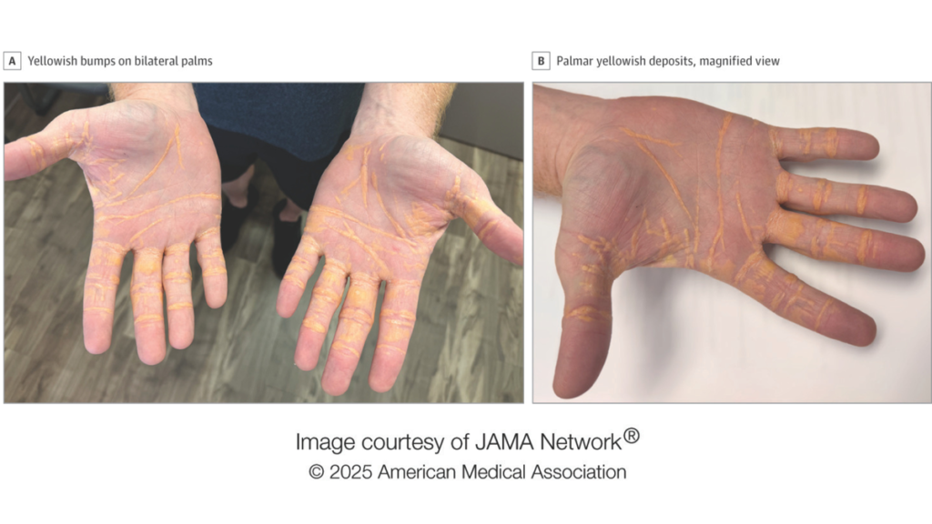 ‘Carnivore diet’ caused yellow lumps to grow on man’s hands and feet