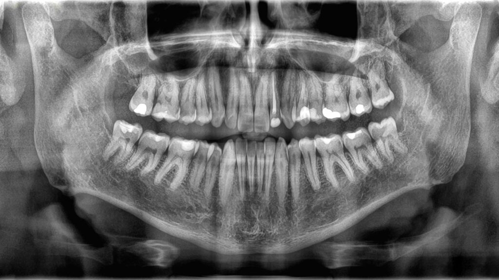 Why don’t teeth count as bones?