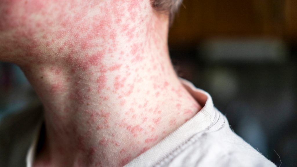 Measles’ resurgence in the US is a grim sign of what’s coming